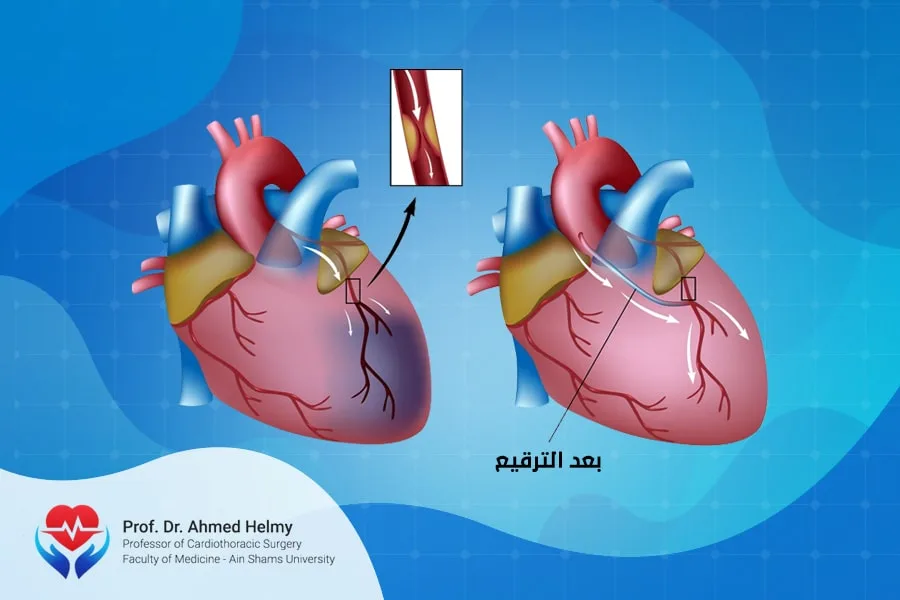 عملية و جراحة ترقيع الشرايين التاجية